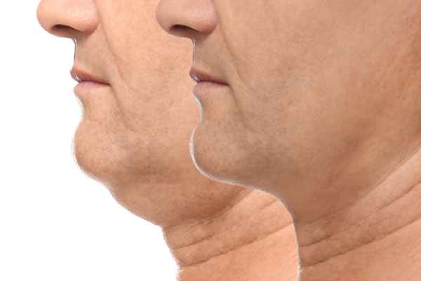 HIFU - Breakthrough in Anti - ageing 2 hifu results Sutton Coldfield