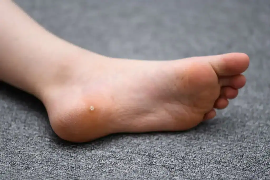 Cryotherapy For Warts And Also Verrucas 2 Image of verruca on the bottom of the foot that able to be treated with Cryotherapy Sutton Coldfield