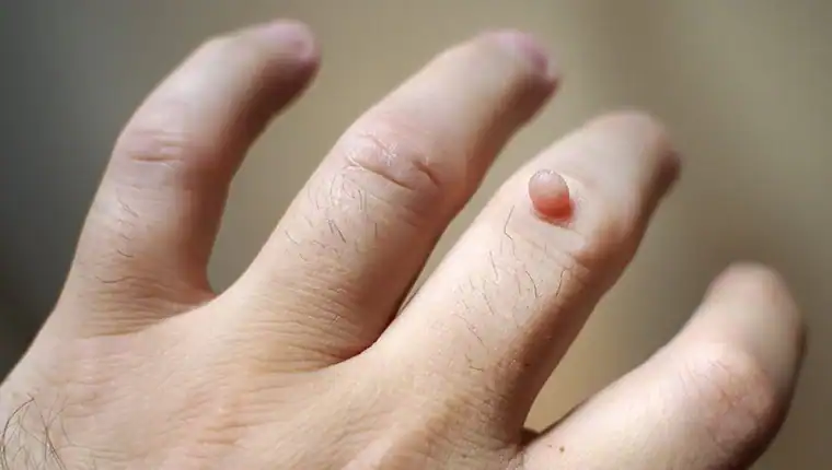 Image of blemish that Cryotherapy Sutton Coldfield can remove with Lipo 360.
