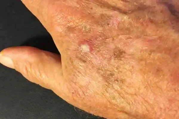 Cryopen For Actinic Keratoses 1 Image of Actinic keratoses Sutton Coldfield on a person hand
