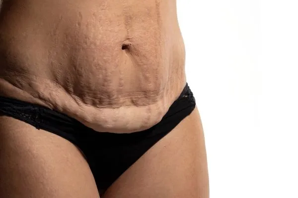 The Science of Skin Tightening 1 The science behind skin tightening Sutton Coldfield picture of a woman's sagging skin on the stomach